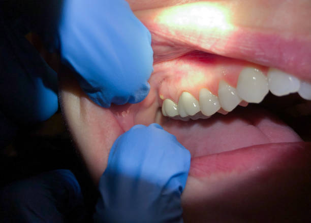Best Emergency Treatment for Oral Infections in Mount Vernon, IN